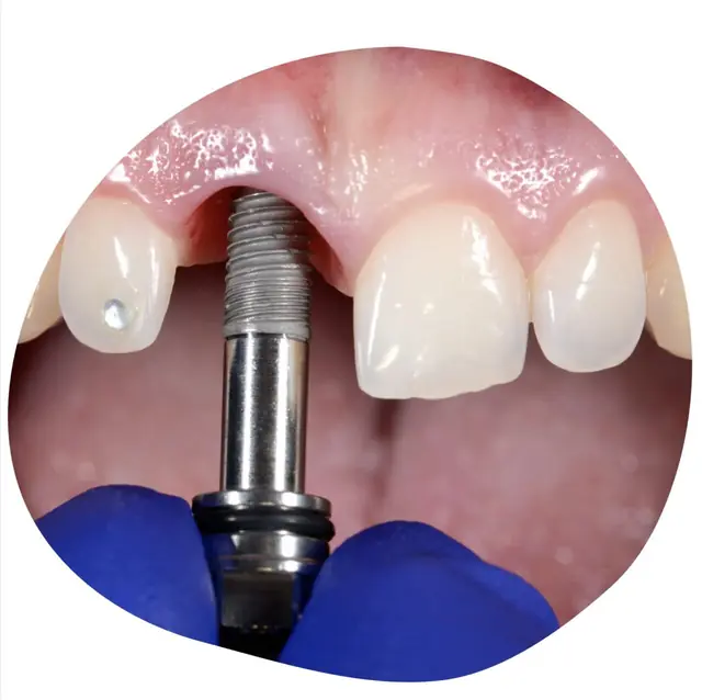 Tooth replacement: a dental implant fixture beside adjacent front teeth