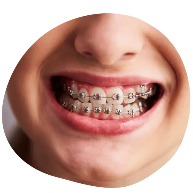 Orthodontics: close-up of teeth fitted with fixed metal dental braces