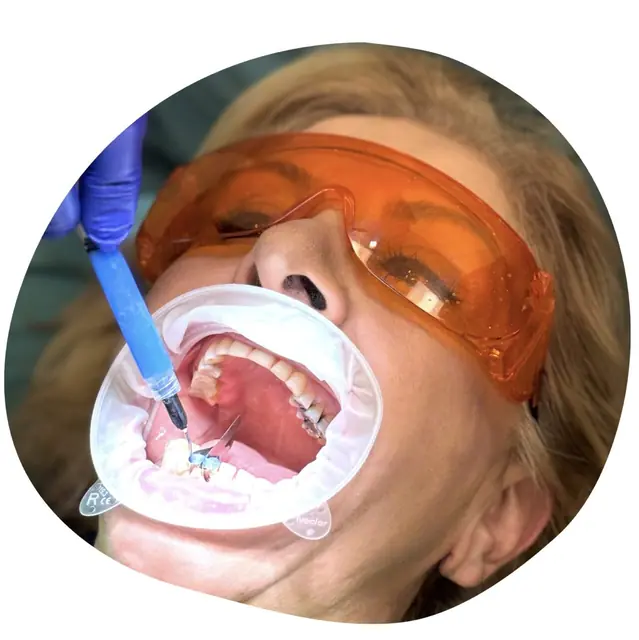 Cosmetic dentistry: a patient wears protective glasses during a dental procedure